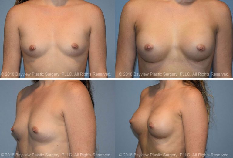breast augmentation cost tacoma