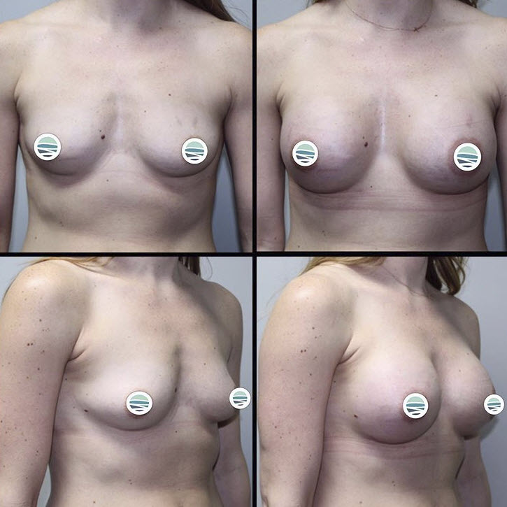 breast implant before and after