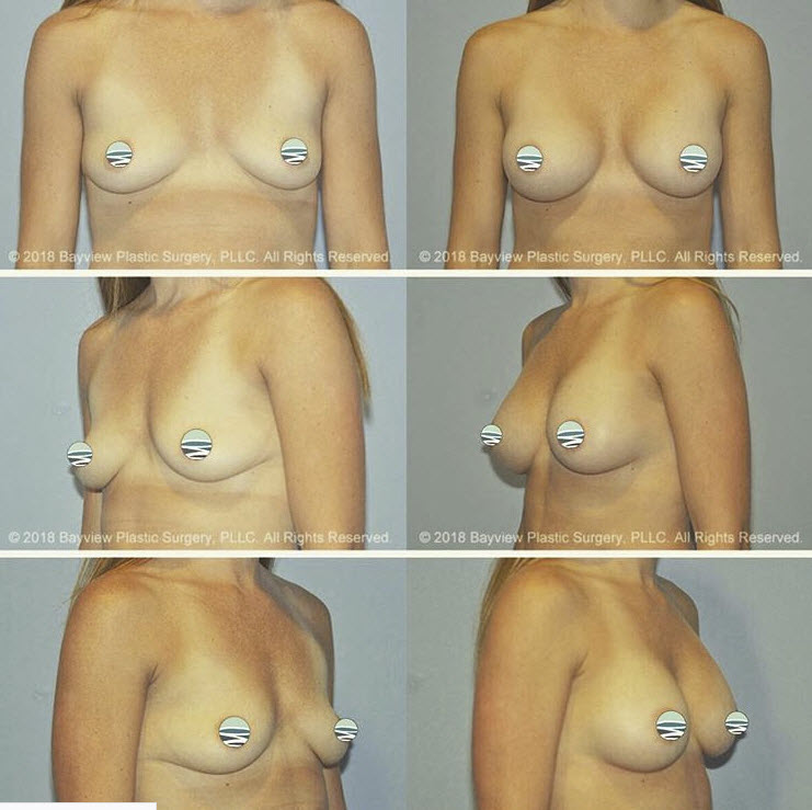 Candidates For Breast Augmentation