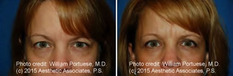 Eyelid Rejuvenation Surgery For Baggy Eyelids