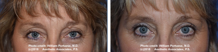 Cosmetic eyelid surgery 