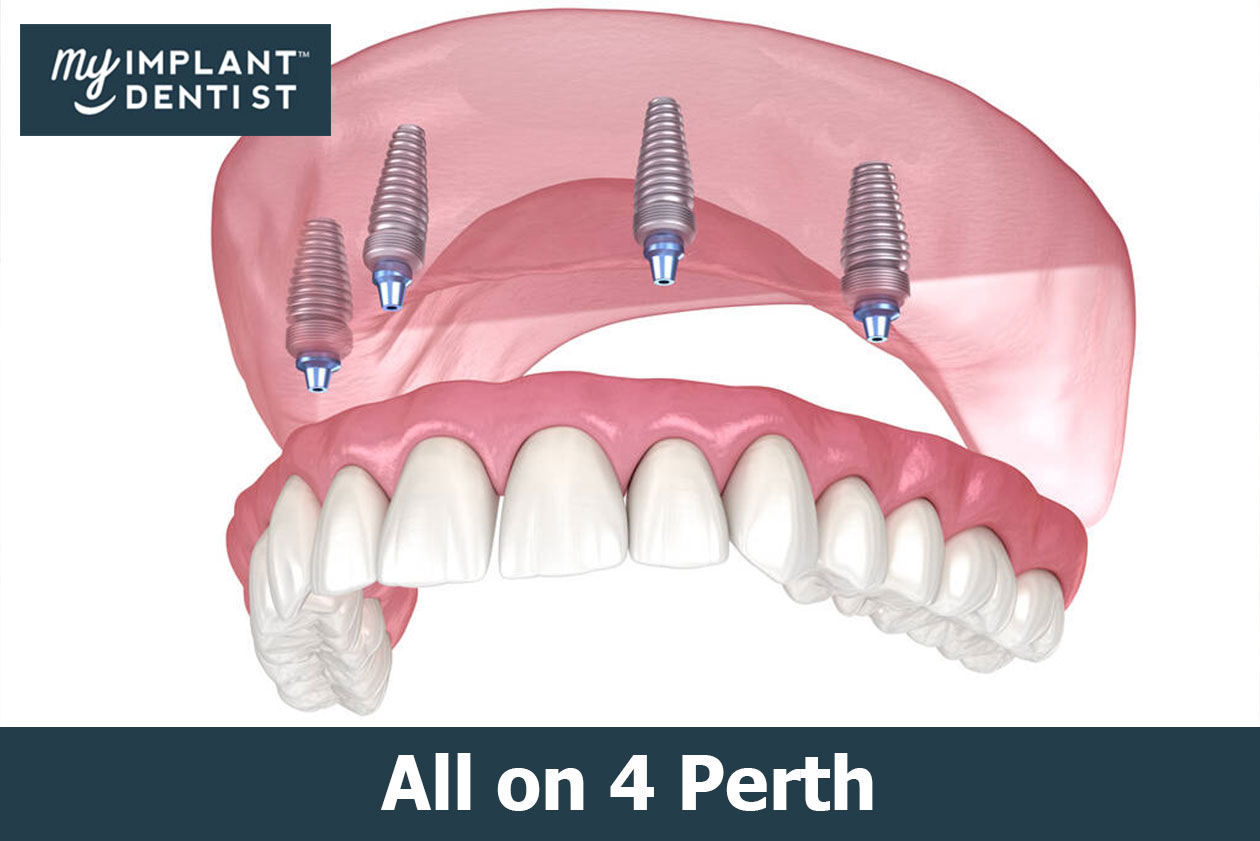 All On 4 Dental Implants Near Me