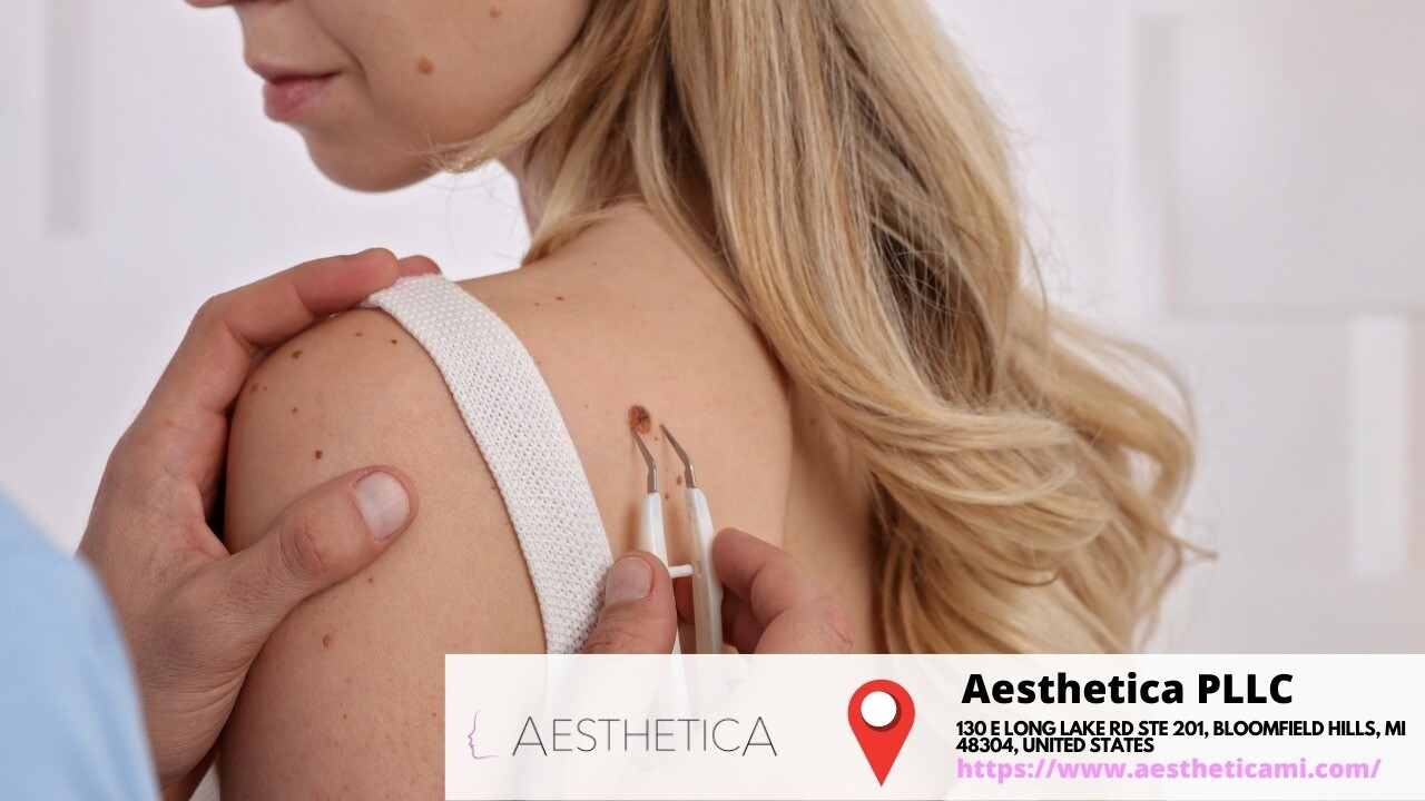 Pdo Thread Lift Treatment To Lift The Mid And Lower Face/neck Near me in in Bloomfield Hills, MI
