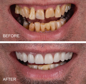 same day dental implant bridge