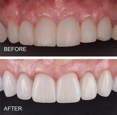 how much do dental implants cost