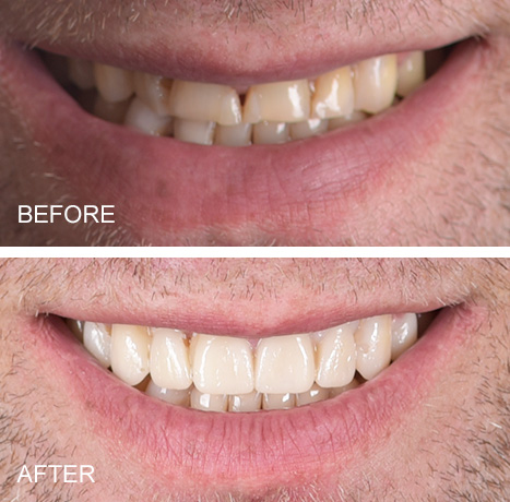 how do same day dental implants work