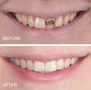 same day dentures and implants