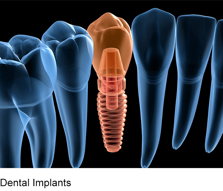 who is eligible for same day dental implants