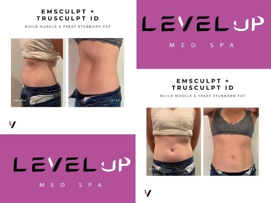 emsculpt neo before and after Lawrence MA 01840