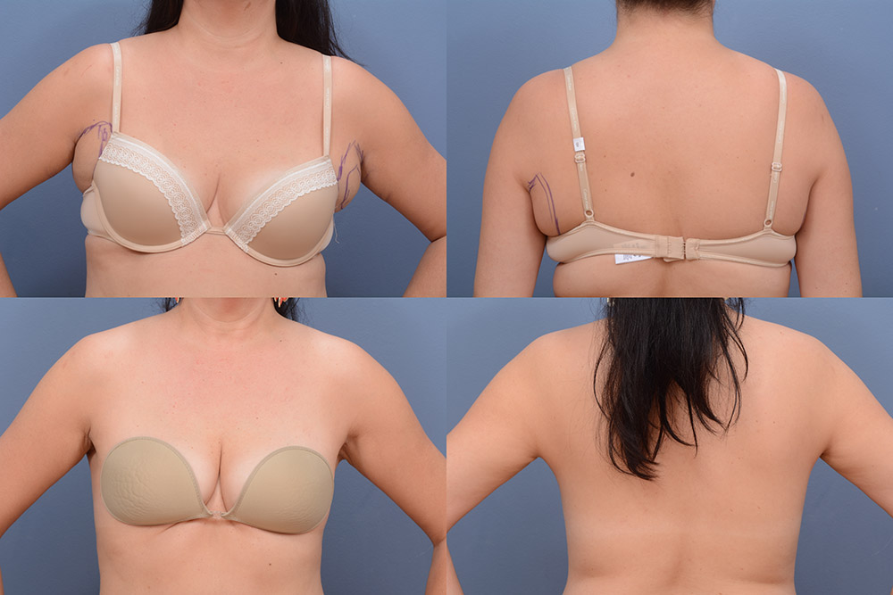Breast Reduction Surgery Tampa FL