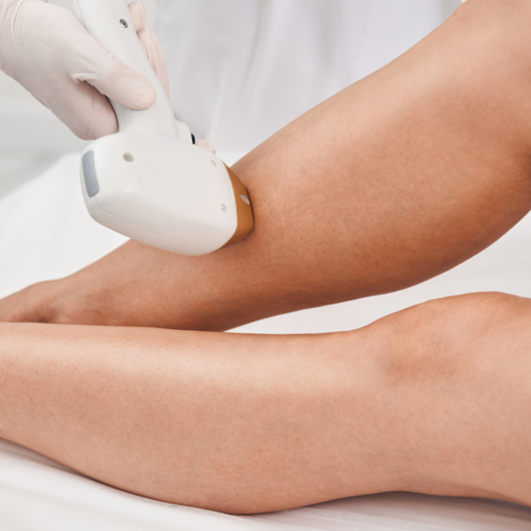 laser hair removal services