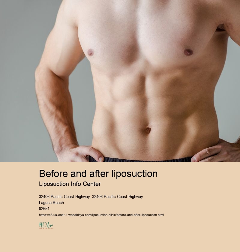 before and after liposuction