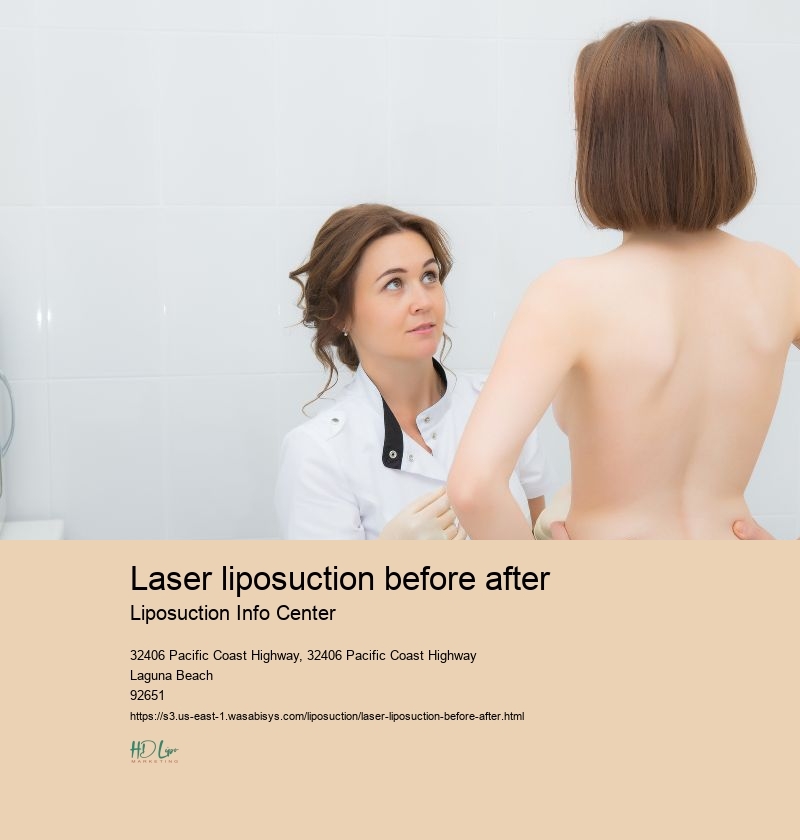 laser liposuction before after