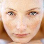 Tratamento Melasma