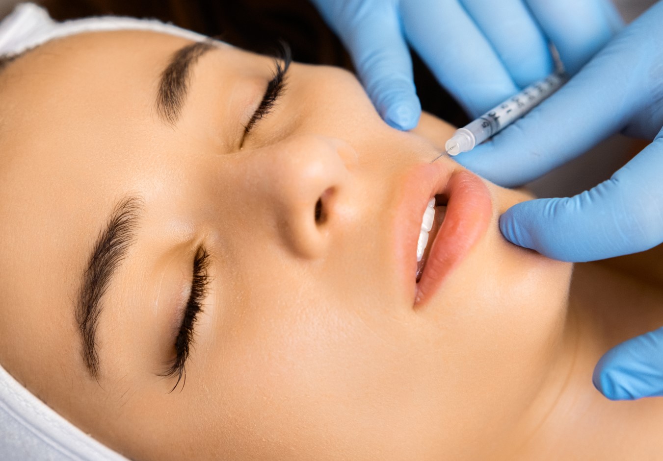 How long does filler last in lips?