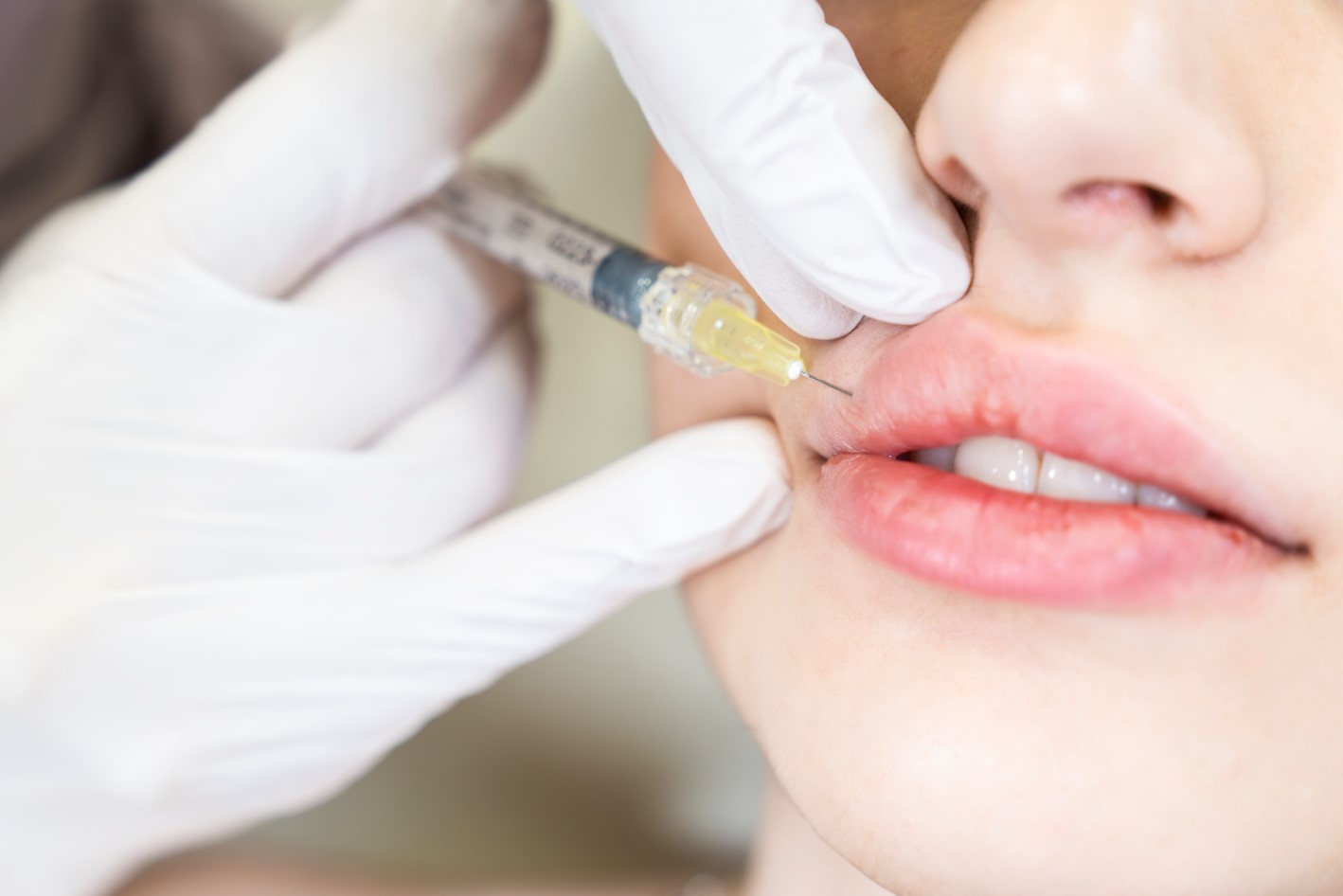 Lip Fillers in Reno