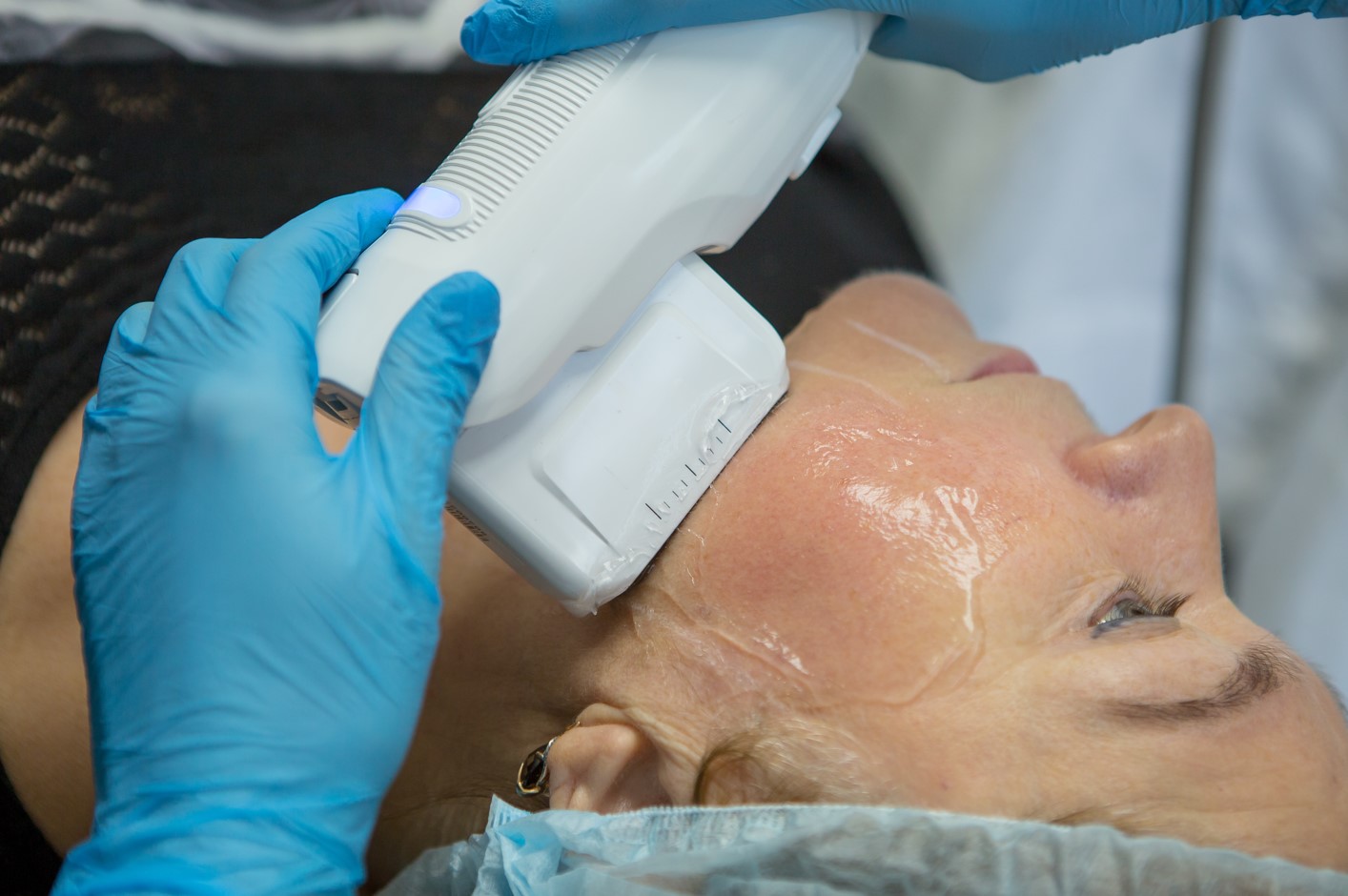 Ultherapy in Reno