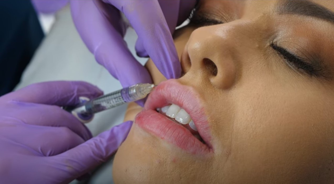 What are the pros and cons of lip fillers?