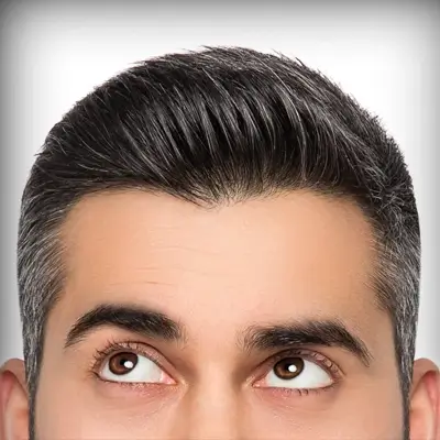 Bay Area NeoGraft Hair Transplantation