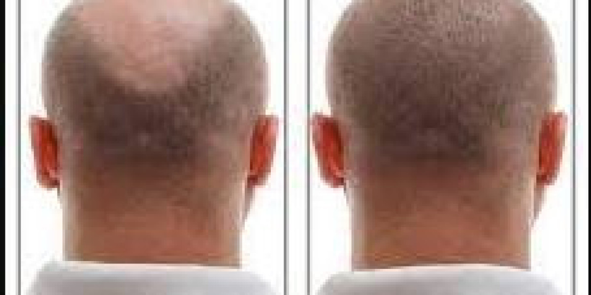 Frisco Regrow Hair: Unlock Your Full Hair Potential