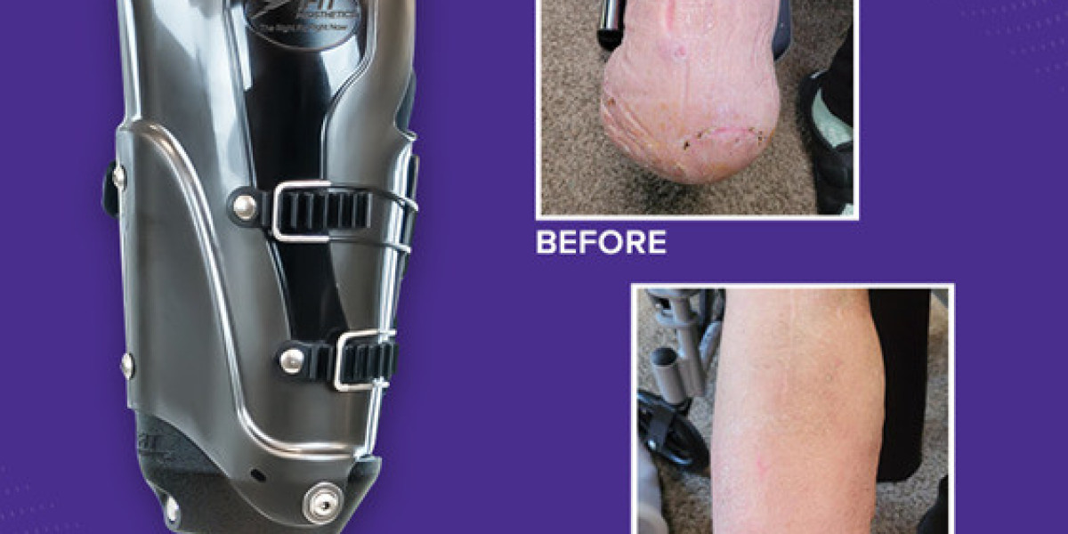 IFIT Prosthetics: Enhancing Mobility with Advanced Prosthetic Sockets
