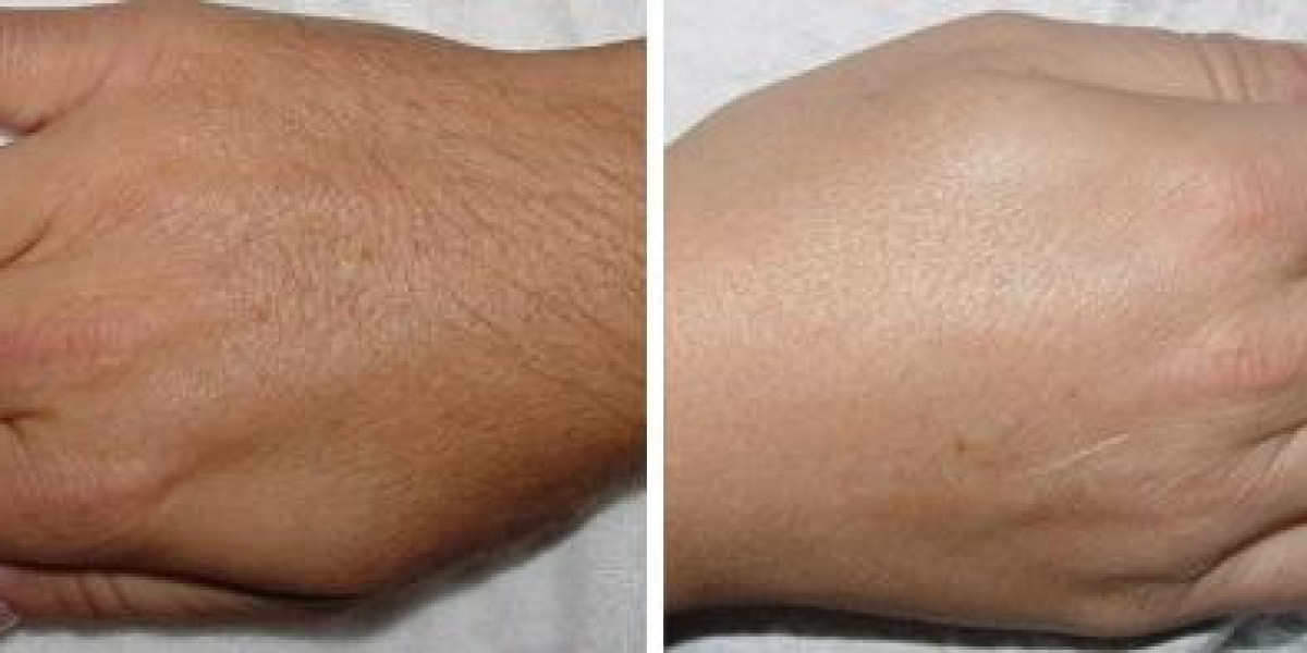 Laser Hair Removal in Houston: Say Goodbye to Unwanted Hair: