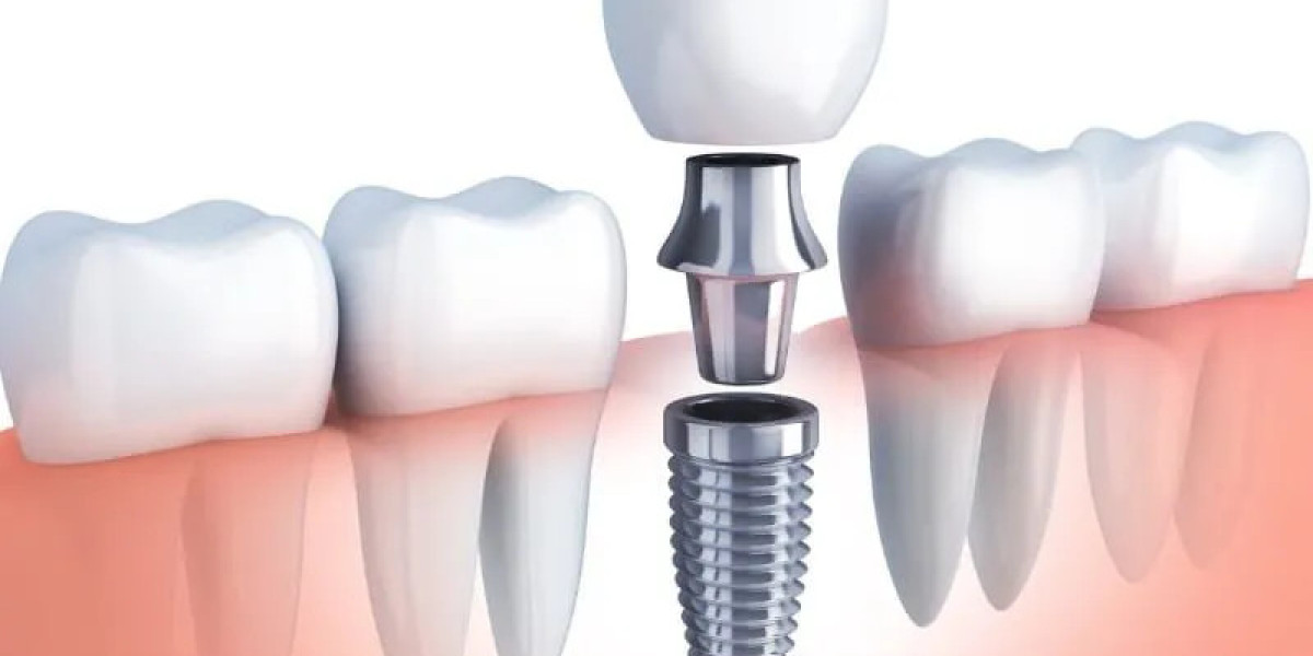 Tooth Replacement Services in McKinney Tx