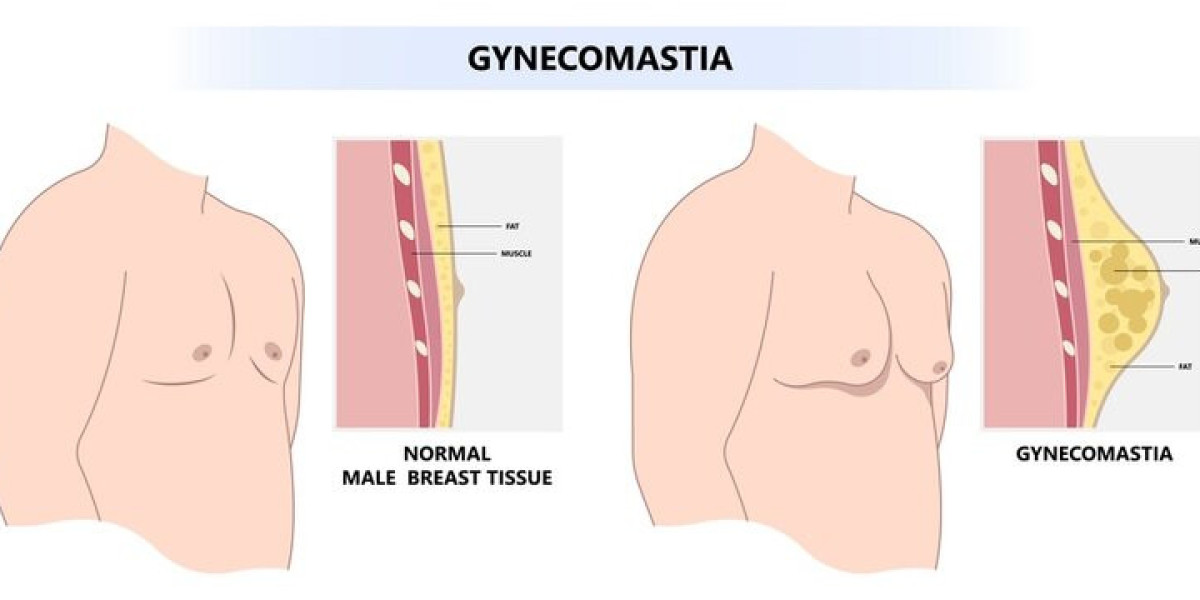 Gynecomastia Treatment Options: US, UK, South Korea & France Markets (2024 Update)
