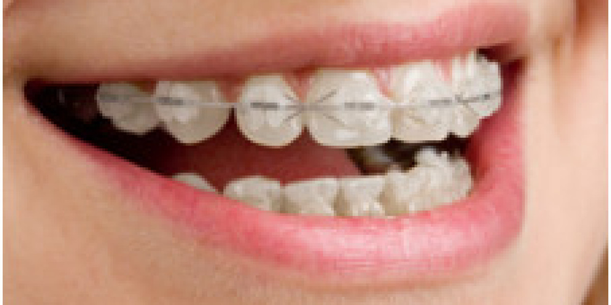 Clear Braces in Evansville: A Comprehensive Guide to a Beautiful Smile