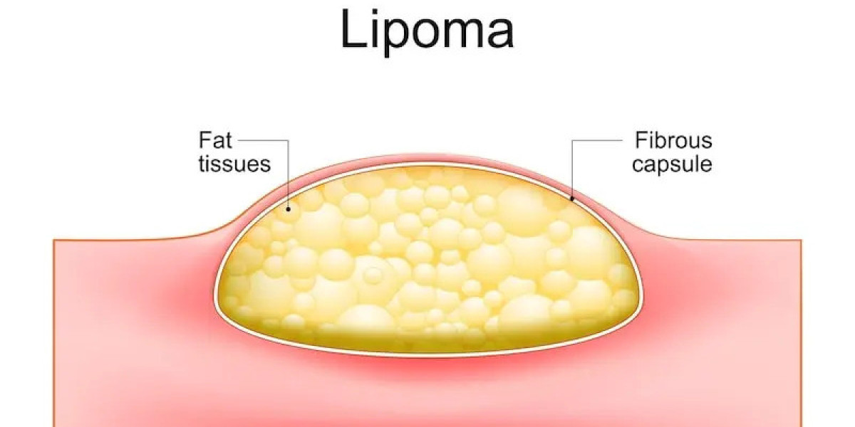 Lipoma: Symptoms, Treatments, and When to Seek Help