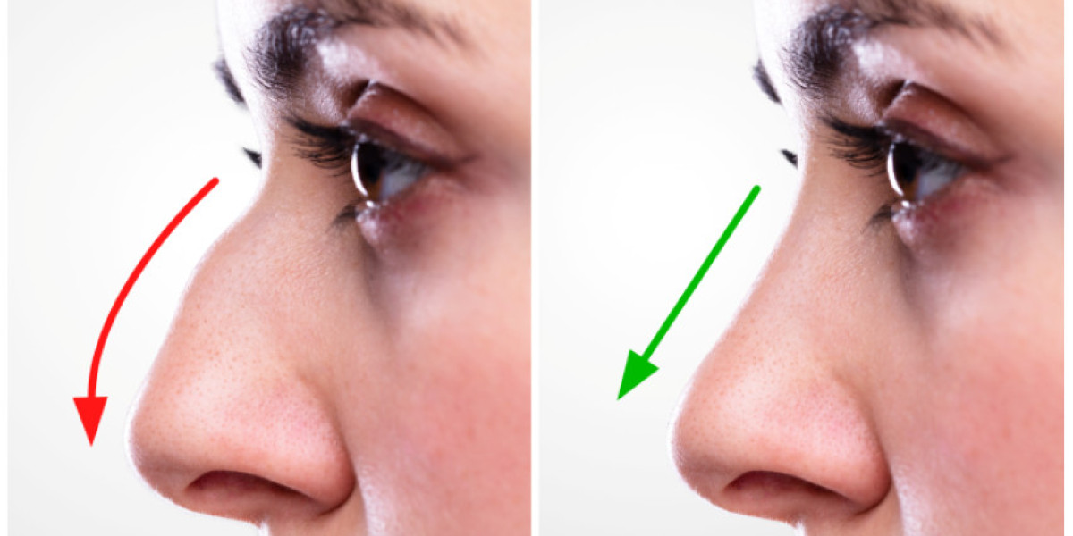 Finding the Best Rhinoplasty Surgeon in Lahore: A Comprehensive Guide