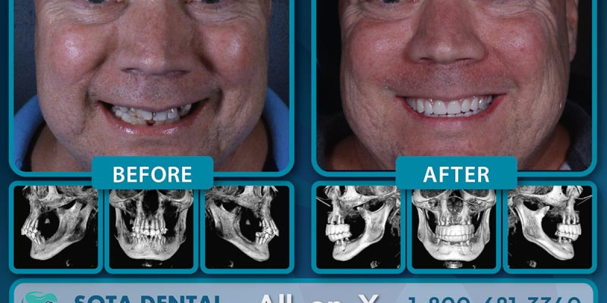 full mouth dental implants Cancun