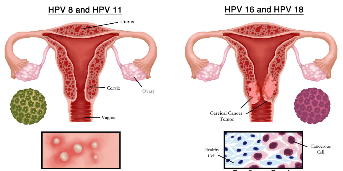 Human Papillomavirus (HPV) Drug Pipeline Analysis