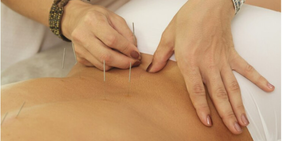 Acupuncture for Weight Loss: A Natural Path to a Healthier You"