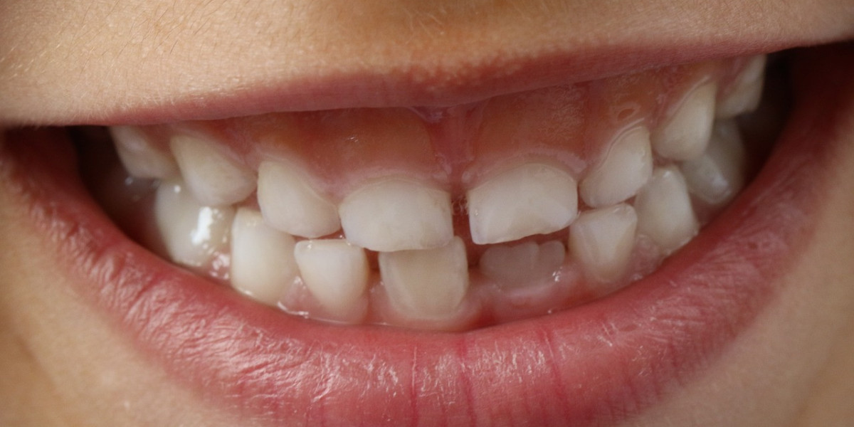 Replace Missing Teeth in a Single Day: Same-Day Dental Solutions