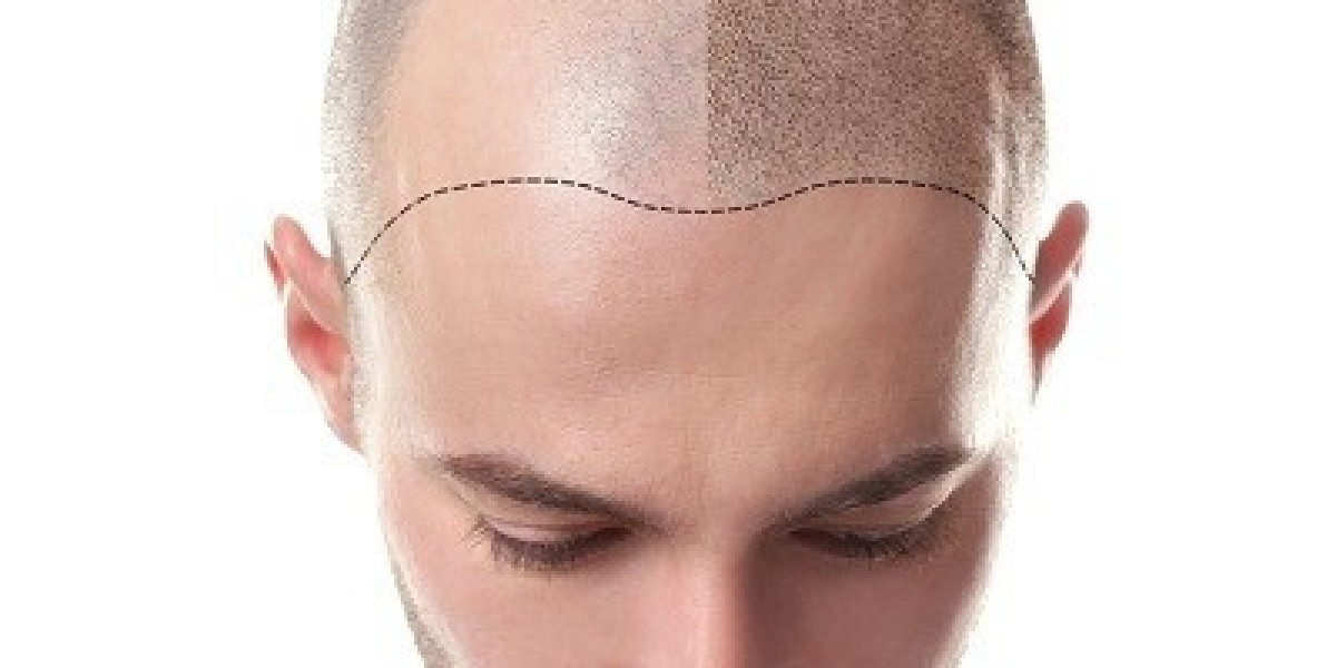 Hair Transplant Solutions for Thinning Hair in Islamabad