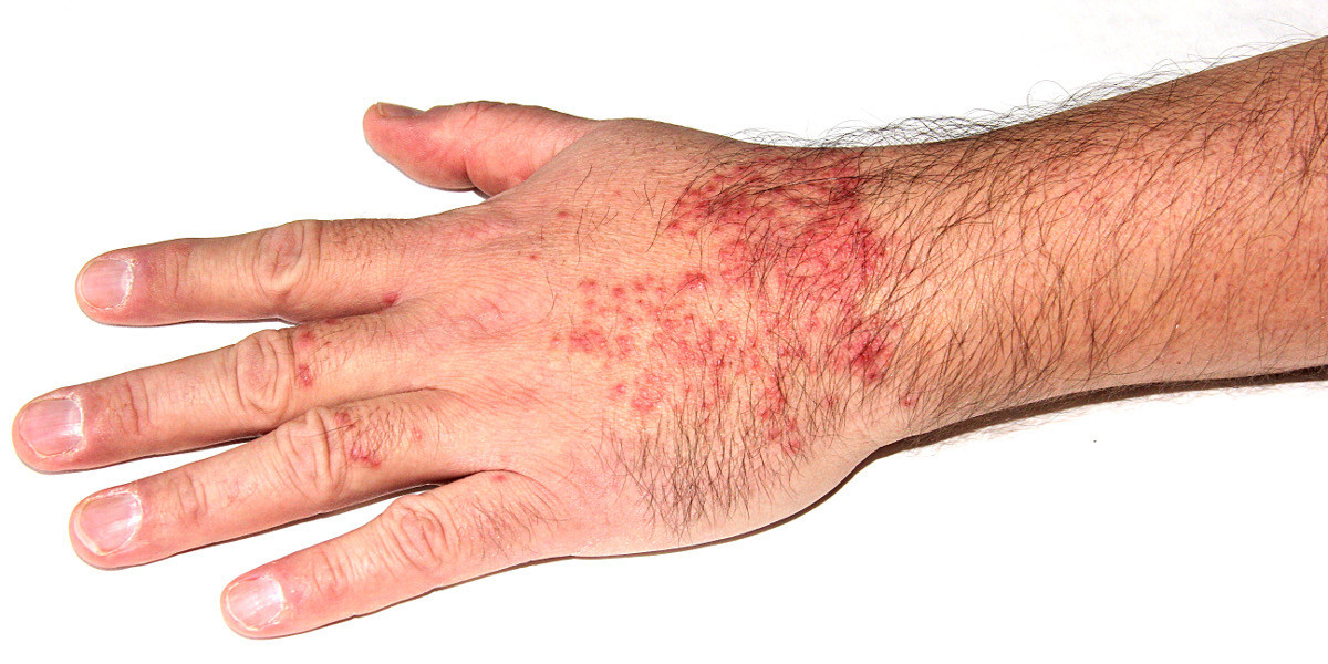 OPZELURA for Atopic Dermatitis: A Breakthrough in Topical Treatment