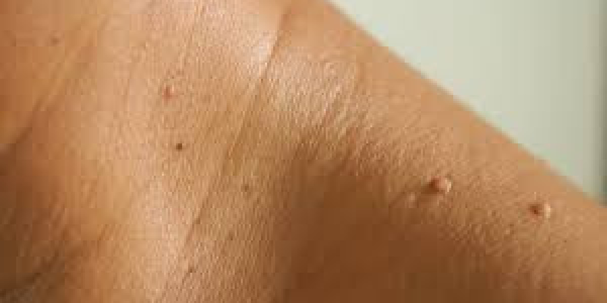 Skin Tag Removal Dermatologist