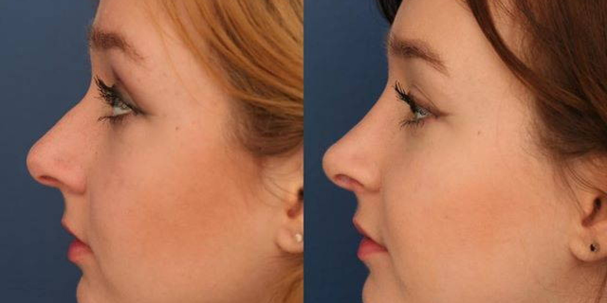 Get the Nose You’ve Always Wanted with Rhinoplasty in Riyadh