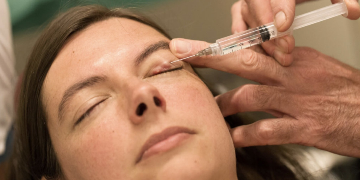 Understanding Chalazion Removal A Comprehensive Guide