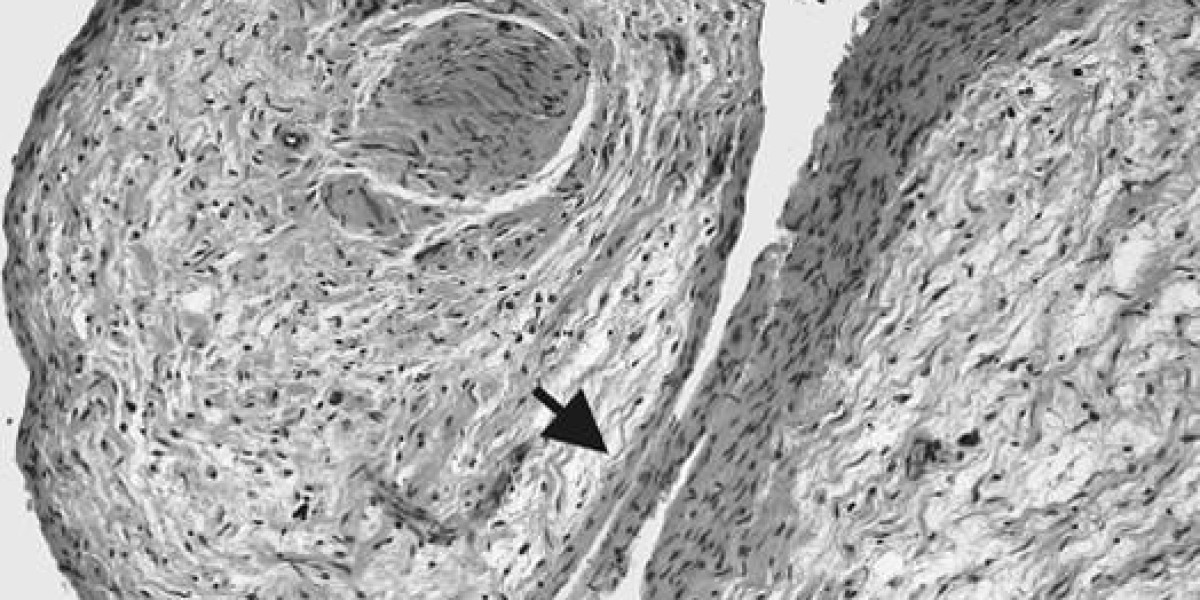 New Horizons in the Treatment of Neurofibromatosis Type One-Associated Plexiform Neurofibromas: Clinical Insights and Ma