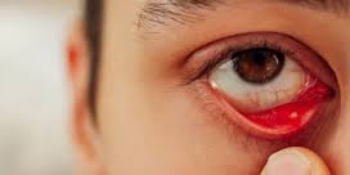 Giant Papillary Conjunctivitis (GPC) Market: Trends, Growth, and Future Outlook