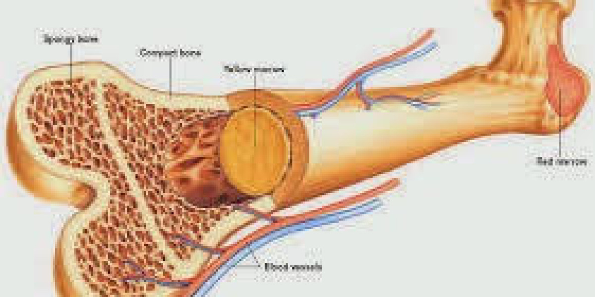 Understanding Bone Cancer Treatment Costs in India with Cross Border Care