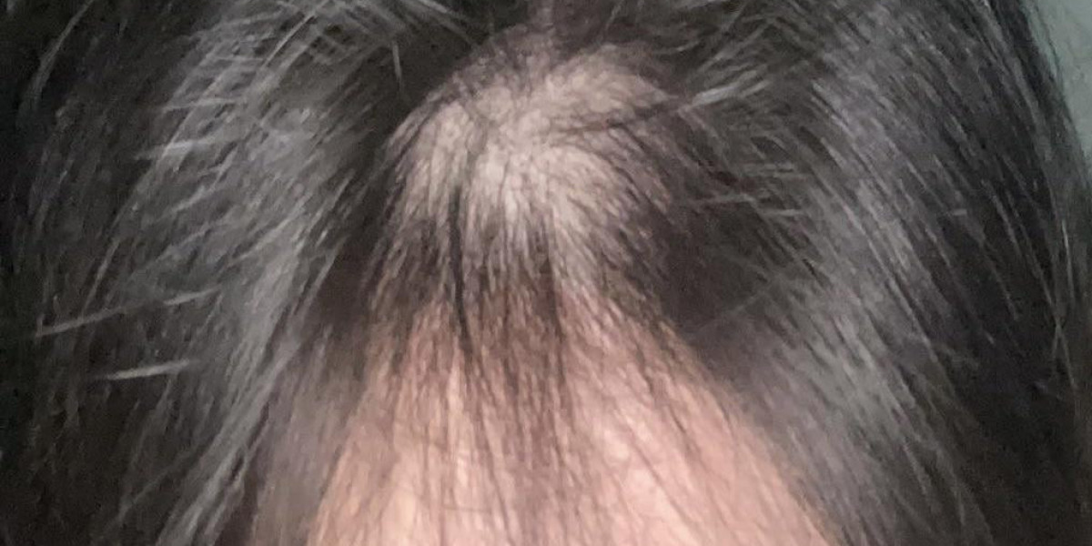 The Truth About Does Saxenda Cause Hair Loss