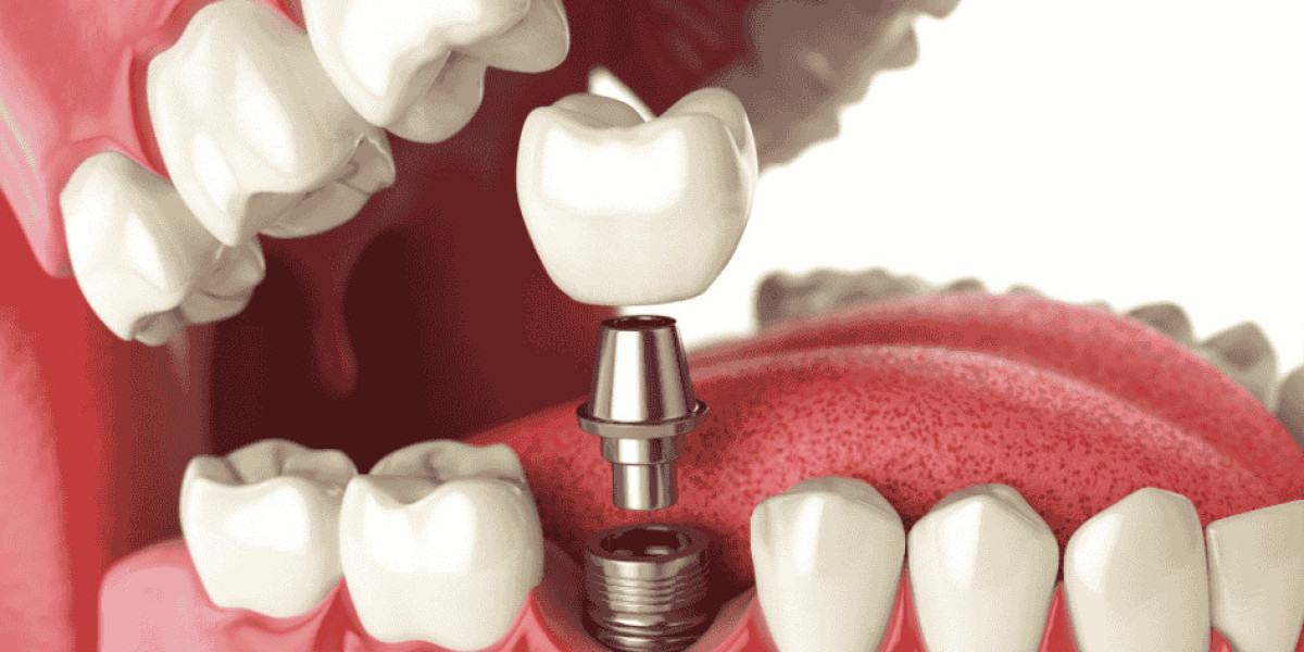 Top 10 Benefits of Dental Implants You Should Know About