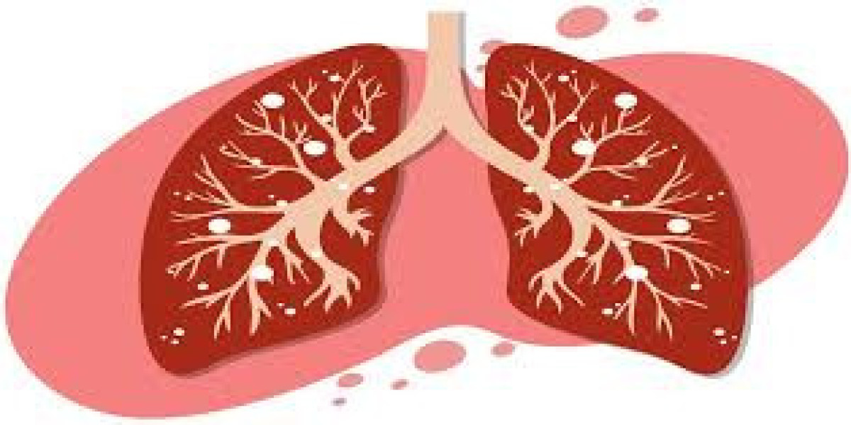 Bronchitis Treatment Market Outlook 2021–2030: Growth, Forecast, and Regional Insights
