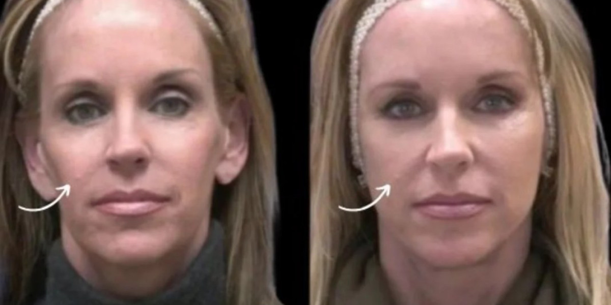 Medical Perspective: Sculptra Fillers at the Best Aesthetic Clinic in Dubai