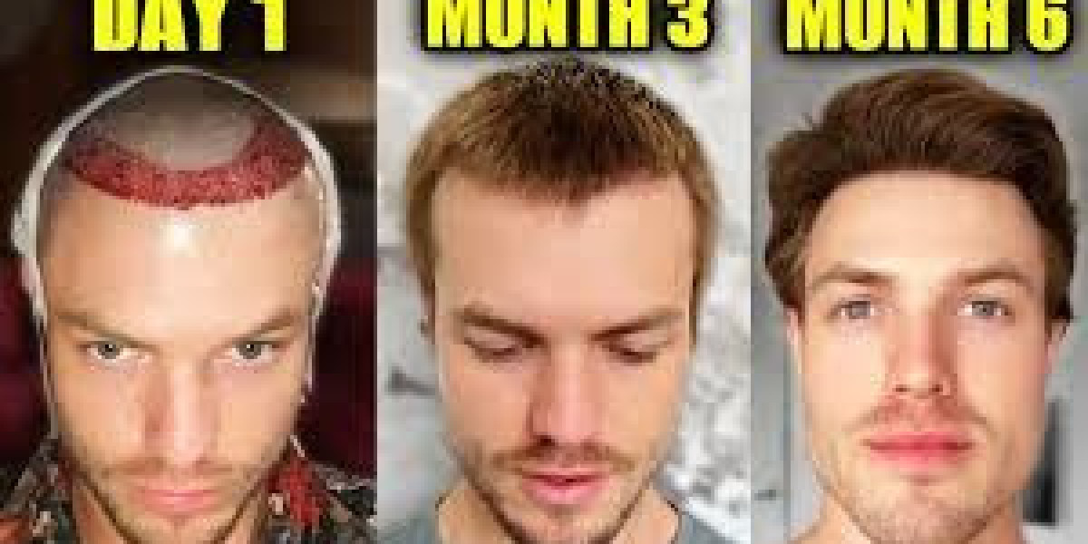 Why Turkey Is the Best Place in the World for Hair Transplantation
