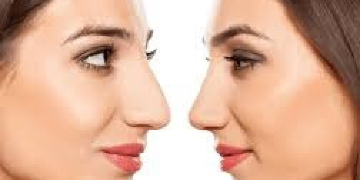 تصحيح انحراف الأنف بالجراحة – ما الذي يجب معرفته؟