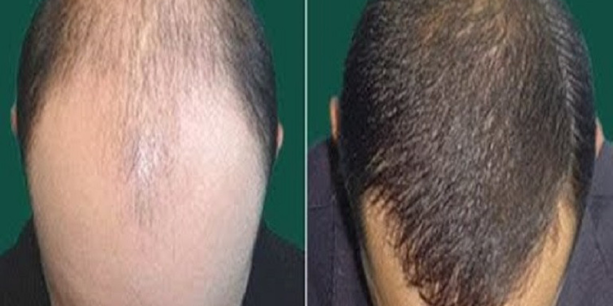 Latest Innovations in Hair Transplant Technology in Riyadh